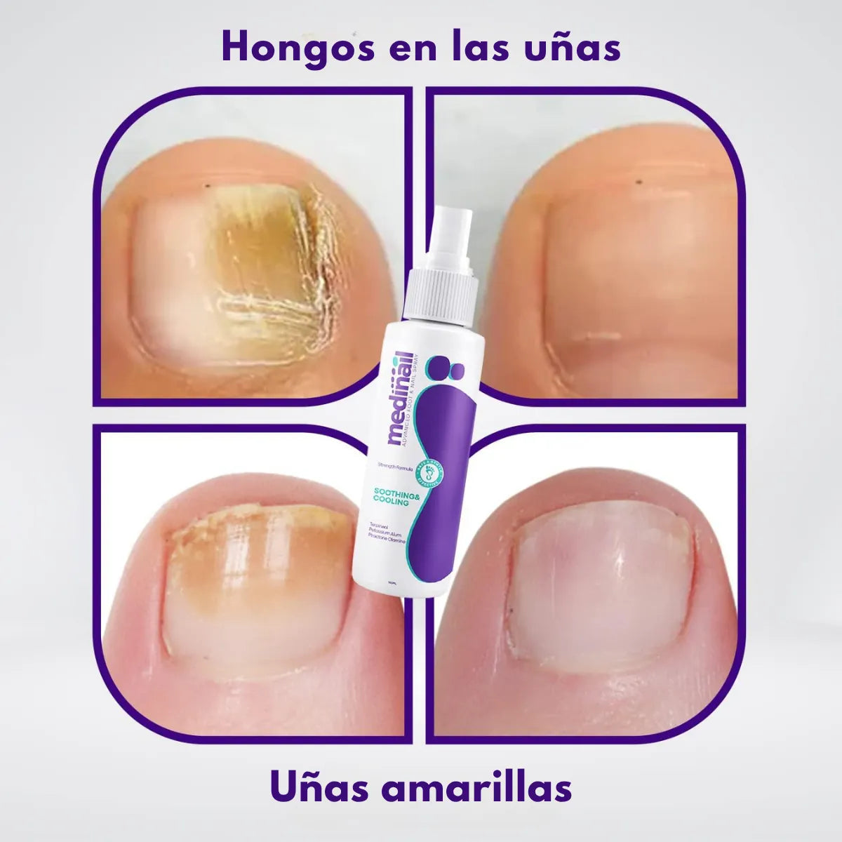 ¡Super Oferta!  Medinail Spray – ¿Listo para volver a lucir uñas limpias y saludables?
