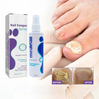 ¡Super Oferta!  Medinail Spray – ¿Listo para volver a lucir uñas limpias y saludables?